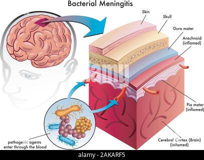 Illustration médicale des symptômes de méningite bactérienne. Illustration de Vecteur