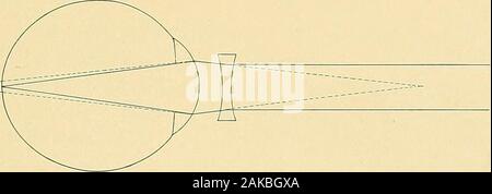 Anatomie chirurgicale : un traité sur l'anatomie humaine dans son application à la pratique de la médecine et de la chirurgie. L'oeil myope.. G OEIL AVEC LA LENTILLE CONCAVE, Banque D'Images