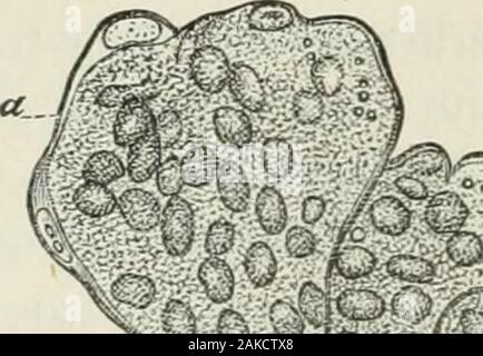 Un traité sur le diabète et la maladie de Bright, avec une référence particulière à la pathologie et therapeuticsIncluding une section sur la rétinite dans la maladie d'lumineux . Préparations ses subdivisions sont facilement recogniza-ble. L'épithélium de l'exhibitssimply glomerule comme une règle de l'enflure, en particulier la partie nucléaire, ainsi que l'extension de l'amarked simples cellules dont la convexité a aradius considérablement plus long que la normale, correspondant à theincreased lumen du capillaire. Les capillaires themselvesare ont augmenté de diamètre de 0,03 mm. (G^"). Après dépose de l'épithélium de la glome Banque D'Images