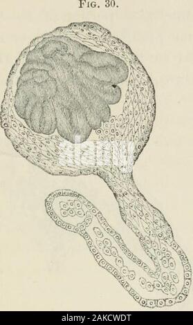 Un traité sur le diabète et la maladie de Bright, avec une référence particulière à la pathologie et therapeuticsIncluding une section sur la rétinite dans la maladie d'lumineux . Degré de l'altération se produit dans l'une des formes de la maladie de Bright.Augmentation du nombre de cellules, résultant en couches stratifiées,est beaucoup plus rare, mais il inacute Langhans a vu la néphropathie lupique où il y avait des hémorragies dans le cap-sule. Ici le corps de Malpighi est allongé dans un directionparallel avec l'axe de la rayons médullaires. Cela est dû à la présence entre la capsule et l'glomerule d'un cres-centic masse de cel Banque D'Images