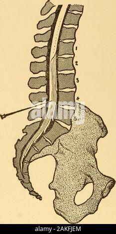 Anaesthesia anaesthetics et général et local . Fig. 47.-crêtes iliaques. brae est généralement sélectionnée. Chipault utilisé l'espace entre les couples lesvis vertèbre lombaire et le sacrum, qui est aussi byRodman préféré. Corning d'abord utilisé l'espace entre le eleventhand douzième vertèbres dorsales, mais plus tard préféré que thefourth entre et la cinquième vertèbre lombaire. Tait et Cagliari, de SanFrancisco, ont injecté aussi haut que le sixième de l'espace cervical, butmost injections condamner les autorités plus que le secondlumbar vertèbre. Emplacement et mode. La position latérale et la technique 162 LA RACHIANESTHÉSIE alre Banque D'Images