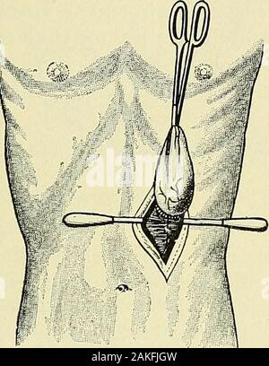 Un manuel de la chirurgie moderne : une exposition des doctrines et des procédures approuvées de l'heure actuelle, à l'usage des étudiants et des praticiens . Méthode Witzels : gastrostomie. Tube en posi-tion ; suture prêt à fermer la paroi abdominale.(Richardson.) GASTBOTOMY. 627 et sous le pont de la peau, de faire sa sortie près de la frontière de la côte, où la peau est incisée. Ici le processus de l'estomac est cousue puis ouvert pour que l'orifice d'introduction de l'alimentation. Au début, de petites quantités d'peptonized aliments liquides sont administrés.Plus tard la nourriture solide peut être masticated par le pa Banque D'Images