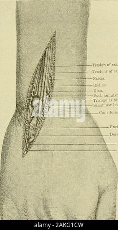 Un manuel de la chirurgie moderne : une exposition des doctrines et des procédures approuvées de l'heure actuelle, à l'usage des étudiants et praticiens . bout deux pouces abovethe ligne de l'articulation, et s'effectue vers le bas près de parallelwith l'axe de l'humérus à la tête du radius. Alors itscourse est altérée et il s'exécute à un point sur la frontière postérieure du theulna à environ trois pouces au-dessous de la pointe de l'olécrâne. Dans le cours de son latterpart il suit la ligne de la bordure extérieure de l'anconeus.Après les pièces jointes ont été suffisamment rompu, la fo Banque D'Images