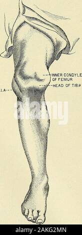 Un manuel de la chirurgie moderne : une exposition des doctrines et des procédures approuvées de l'heure actuelle, à l'usage des étudiants et praticiens . itsaxis à déclaré de façon à se tenir sur un bord, l'Orit peut être tourné entièrement au-dessus de sorte que la surface cartilagineuse est directement sous la peau. Le déplacement vers l'extérieur plus courante que l'intérieur, en raison de la manière dont oblique et themuscular theextensor les fibres tendineuses du muscle sont attachés à elle andbecause de la taille et de la forme de l'ar-ment surface du condyle externe.L'autre luxations de la rotule d'un Banque D'Images