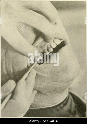 Pathologie dentaire général et, en particulier, sur l'étiologie et de l'anatomie pathologique ; un traité pour les étudiants et les praticiens . J1- •&gt ; ?-Pyorrhée alveolaris dans les dents du bas dans la même affaire, comme illustré en Fig.395. Mouvement distal des dents. Perte considérable de l'os alvéolaire et péri-membrane dentaire entre les incisives centrales inférieures.. Fig. 39S.-Pyorrhée alveolaris dans le coin supérieur droit canines première prémolaires et molaires en premier. complete destruction de gencive et la destruction des processus alvéolaire et peridentalmembrane sur une distance de quelques millimètres. lYORKIIKA l. EOLARIS EST ! Banque D'Images