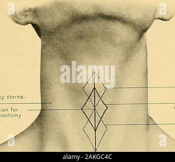 Anatomie chirurgicale : un traité sur l'anatomie humaine dans son application à la pratique de la médecine et de la chirurgie. Une carotide commune. ininferior.triangle carotide partie 3d d'un sous-clavière un innommé LIGNES D'INCISION POUR L'exposition d'artères et de nerfs.20 CLlll LA PLAQUE, l'importance produit par sternomastoid m. La ligne commune d'forlaryngotomy higiT traclieotomyand incision.bas traclieotomy. Banque D'Images