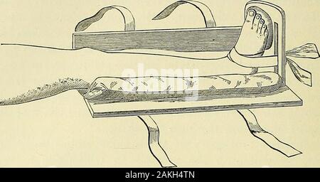 Un manuel de la chirurgie moderne : une exposition des doctrines et des procédures approuvées de l'heure actuelle, à l'usage des étudiants et praticiens . d avec onehand tandis que l'extrémité inférieure de la jambe est saisi avec l'autre. Les articulations du tarse Motionin ne doit pas être confondu avec le mouvement de la cheville. Fracture de la partie inférieure du péroné peuvent souvent être détectées byplacing les doigts derrière le tiers supérieur de son axe et endeavoringto la lever de l'avant. Si cela provoque une douleur sur la partie inférieure de thebone, il est évident que le péroné est fracturé et déplacés au point de douleur. Redevance Banque D'Images