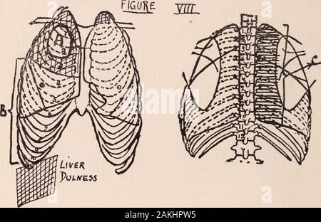 Albany Medical annals . est décédé Février-6 avril. Aucune autopsie n'a été obtenue. Cas II. M. O. C, l'âge de 35 ans, fer à repasser moulder. a admis le 25 mars 1912, visé par le Dr Sharkey.de Rensselaer. À l'entrée de son état était faible, avec dyspnée. Il hadhad une hémorragie et ses crachats a été positive. 92 PNEUMOTHORAX, AVEC UN RAPPORT DE TROIS CAS L'examen de la poitrine ont montré (voir Fig. V), sur l'inspection, noinspiratory d'excursion de poitrine sur le côté droit et que juste sur le côté gauche de l'apex en 5e,battre interspace quatre pouces et demi à gauche de la mi-ligne sternale et trois quarts de pouce à gauche de la ligne de mamelon, légère Banque D'Images