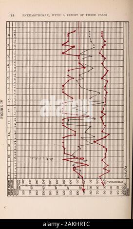 Albany Medical annales . A =Domaine de dulness cardiaque.B =Normal.C =Tympany de résonance. D =Rate affiche ci-dessous marge costale. Côté droit.-résonance accrue et un souffle tubaire-teriorly et l'arrière. Rales sur la respiration calme. Côté gauche-tympany marquée en C avec l'absence des bruits respiratoires.Faible amphoric fremitus murmura avec voix. Il y a B à bron-chial la respiration et l'augmentation de la résonance vocale. Un coup d'œil à son tableau (voir Fig. II) donne la relation entre existant sa température, pouls et respiration en ce moment. Examinationof son coeur était négatif. Il avait de la tubercul Banque D'Images