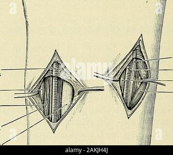 Un manuel de la chirurgie moderne : une exposition des doctrines et des procédures approuvées de l'heure actuelle, à l'usage des étudiants et des praticiens . Avec l'artère brachiale VEN/E COMITESMEDIAN BICIPITAL NERF MÉDIAN FASCIA-CUTANEOUSNERVE INTERNE VEINE BASILIQUE FLEXOR SUBLIMIS D1GITORUMFLEXOR DIGITORUMULNAR CARPI ULNARIS PROFOND FLÉCHISSEUR ULNAIRE ARTÈRE ARTÈRE RADIALE NERF COMITES WITHVENJE LONGUSPOLLICIS FLÉCHISSEUR BRACHIO NERF RADIAL-RADIALISFLEXOR radial deuxième. Nerf CUBITAL CUBITAL ARTERYFLEXOR DIGITORUMFLEXOR SUBLIMIS CARPI ULNARIS FLÉCHISSEUR RADIAL DEUXIÈME ARTÈRE RADIALE OSSI EXTENSORES Banque D'Images