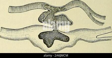 Un manuel de la chirurgie moderne : une exposition des doctrines et des procédures approuvées de l'heure actuelle, à l'usage des étudiants et des praticiens . Première forme de fistule artério-veineuse.(Wyeth.) deuxième forme de fistule artério-veineuse.(Wyeth.) tion de la veine à l'emplacement de la fistule, et conduit à hypertrophyand tortuosité des veines elle et d'autres dans les environs. Blessures artério-veineux ET FISTULES. 277 la vibration et le bruit peut être transmis le long des veines pour aconsiderable la distance de l'ouverture, en particulier est-ce le cas inan vers le haut. Le gonflement, vibrati Banque D'Images