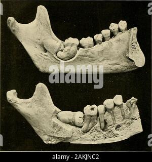 Principes et pratique de la dentisterie opératoire . Fig. 717.-d'après le Dr M. H. Cryer. Banque D'Images