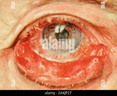 Atlas et incarnation de coopératives d'ophtalmologie . splantation,la première règle doit être de préserver la marge palpébrale et de la partie de la paupière comme presque intact que possible,parce qu'il est presque indispensable au bon framingof la fente palpébrale étroite. Dans de nombreuses opérations de ce type tarsorrhaphy, tem-poral ou suture des couvercle égaré devient nécessaire, mesure auxiliaire asan. Tout d'abord le couvercle dans ces cas d'être ectropionmust cicatricielle rendu parfaitement biens meubles en séparant les andexcising les cicatrices, afin qu'il puisse être restauré asnearly que possible à ses conditions normales de posit Banque D'Images