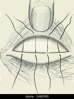 Atlas et incarnation de coopératives d'ophtalmologie . rightacross ried le couvercle. Cette incision doit suivre le curvedline du bord supérieur du tarse, c'est l'ampleur de l'objet de variations individuelles. Lorsque l'oeil est closedthe bord du tarse est facilement reconnue par un delicatewrinkle dans la peau, en commençant environ 2 mm au-dessus et l'augmentation des canthus intérieur doucement vers le milieu du couvercle,et de ce point de tomber progressivement à l'externe peut ainsi. Comme il est difficile, compte tenu de l'extrême faiblesse de 312 OPÉRATIONS SUR L'oeil. la peau de la paupière supérieure, de suivre cette courbe avec aknife, Banque D'Images