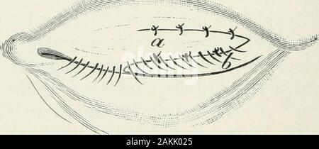 Atlas et incarnation de coopératives d'ophtalmologie . Fig. 130.-fonctionnement du trichiasis par Spencer Watson. parce que, après l'aiguille a été introduite en thefollicle près de la CIL, la fermeture de l'electriccurrent causes plutôt la douleur grave. Après de 5 à tenseconds, au cours de laquelle de petites bulles d'hydrogène emergefrom le tissu autour de l'aiguille, le follicule se bedestroyed, tel qu'il appert du fait que le cil eitherfollows l'aiguille qu'elle est retirée ou est retiré par Avery légère traction avec la pince ; s'il n'a pas beendestroyed la procédure doit être répétée. Pour les opérations Banque D'Images