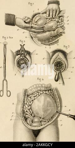 Iconographique Précis de médecine opératoire et d'Anatomie chirurgicale . sur du pessaire doit être précédée dune opération autrepetite : la réduction de lorgane renversé ou déplacé. Pour réduire le vagin , sur agit de même que pour la chute d'durectum , sur recouvre la surface du bourrelet avec un linge enduit decérat, et sur le salle de presse doucement avec les doigts, de la cir-conférence au centre. De même pour réduire lutérus renversé, onenveloppe lorgane dun linge graissé , puis, sil y un simple programme latino-américain d'activités démographiques-sus sur lutérus refouler tout en en comprimant la base , tâcherde lamoindrir ; verser si lorgan Banque D'Images