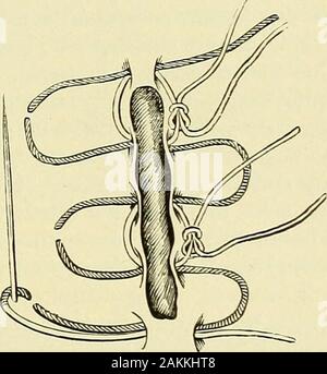 Un manuel de la chirurgie moderne : une exposition des doctrines et des procédures approuvées de l'heure actuelle, à l'usage des étudiants et praticiens . la dépose de ces et d'autres tumeurs, même modérée lorsque le saignement n'est pas souhaitable, est digne d'attention. Avant de faire l'incision qu'il introduit profondément par le tissuessurrounding la croissance et à une certaine distance de lui, de nombreux axes d'longacupressure, et puis les tissus et constriction forte vesselsby afférents liés cordons autour des extrémités de ces broches, comme dans l'axe orharelip suture. Si l'emplacement n'est pas conv Banque D'Images