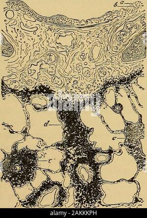 La consommation pulmonaire, pneumonie, et des maladies des poumons : l'étiologie, la pathologie et le traitement, avec un chapitre sur le diagnostic physique . 300. Un Diams, lumen bronchique, avec les muqueuses dans membranethrown ; plis b, congestion des capillaires ; r, desquamated et pig-œuvre ; d épithélium alvéolaire alvéolaire des poumons, des cavités.-Hamilton. la bronchite, mais parce que ses vaisseaux sanguins sont andturgid distendu. Chaque texture semble être dans un con-dition oedémateux. En règle générale, l'épithélium est de vouloir, et sur l'freesurface de la membrane de sous-sol, ce qui est gonflé, andedematous sont des nombres de bud-comme Banque D'Images