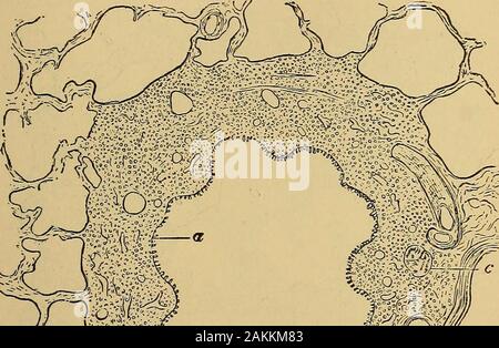 La consommation pulmonaire, pneumonie, et des maladies des poumons : l'étiologie, la pathologie et le traitement, avec un chapitre sur le diagnostic physique . bscesses.Les deux l'intérieur et l'extérieur manteaux fibreux souffrent d markedcellular l'infiltration, et les cartilages et le layerweaken m.musclé et deviennent atrophiés. La couche musculaire des artères thesmall est habituellement épaissi, mais la prostitution d'thecapillaries sont fins et en grandes distendu des sinus, les vésicules, en raison de l'enrôlement forcé des efforts de toux, bronchite chronique incidentalto sont overdistended, ce qui entraîne l'emphysème. topermanent Fig. 44 Banque D'Images