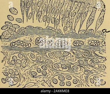 La consommation pulmonaire, pneumonie, et des maladies des poumons : l'étiologie, la pathologie et le traitement, avec un chapitre sur le diagnostic physique . ree ou quatre jours est entièrement enlevés.C'est bien illustré dans les figures suivantes qui aretaken à partir de l'action de M. D. J. Hamilton, qui a déjà été largement cité, et qui sera une takenas guide dans tout ce qui se rapporte à l'pathologyof bronchite chronique, à la fois sa forme aiguë et chronique. En raison de l'oedème, qui est présent dans la bronchite chronique, l'apportée dans d'expectoration séreuse est principalement de caractère, une bronchite aiguë. Banque D'Images