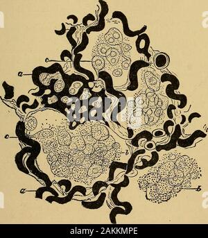 La consommation pulmonaire, pneumonie, et des maladies des poumons : l'étiologie, la pathologie et le traitement, avec un chapitre sur le diagnostic physique . Fig- 39--Section d'une alvéole de poumon d'un personne qui diedfrom, une maladie de la valve mitrale, distendu et capillaires alvéolaires en saillie;b, desquamated ; c, l'épithélium-intoalveolar extravasated sang globules empreinte à Hamilton. Rhumatisme parfois, une pneumonie et une pleurésie croupous,au lieu d'un œdème pulmonaire, sont engendrés. Maintenant, il y a de bonnes raisons de croire qu'catarrhalpneumonia est dépendante de l'exploitation de la même mor-bid principe, bien Banque D'Images