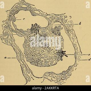 La consommation pulmonaire, pneumonie, et des maladies des poumons : l'étiologie, la pathologie et le traitement, avec un chapitre sur le diagnostic physique et se propage . La messe,vers l'extérieur jusqu'à ce qu'il établit la communication avec abronchial tube lorsque son contenu est déchargée et une cavityin le poumon reste, comme cela a déjà été noté. Caseation marque le début d'une nouvelle époque dans l'histoire de vie de la consommation pulmonaire. Depuis le tout début de ce processus et même après l'excavation a occurredtubercle bacilli, qui presque toujours montrer leur presenceat cette fois, sont absorbés par le système lymphatique vesse Banque D'Images