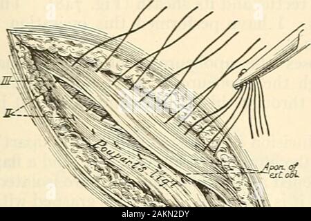 La chirurgie moderne, général et du dispositif . ent (Halsted). La prochaine étape est de porter la trappe inférieure, composée de muscle crémaster, andfascia sous le muscle oblique interne, et il suture il y (Fig. 743). Wenext la suture et le muscle oblique interne tendon conjoint à pou-parties ligament, le bord inférieur de l'imbrication du obhque interne sousle bord du ligament (Fig. 744). Pour ce faire, il peut être nécessaire pour libérer le muscle par incision à la face antérieure de la gaine rectale. Dans Theincision l'oblique externe est maintenant fermé avec des sutures qui chevauchent d'themargins (Figs. 745 un Banque D'Images