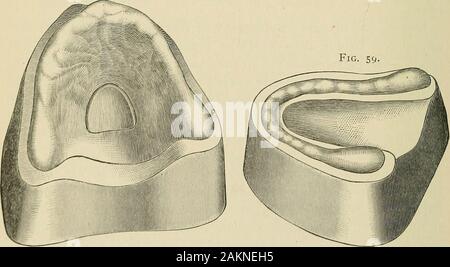 Pratique d'un traité sur l'art dentaire mécanique . Façon d'obtenir un modèle en plâtre d'une impression ou inWax composé de modélisation, pour l'ensemble de l'samegeneral dentiers.-méthode est poursuivi dans l'obtention d'un modèle en plâtre d'un Fig. 58. Fig. 59.. impression de la mâchoire supérieure ou inférieure pour l'ensemble de l'dentureswith les substances mentionnées, que celle employée dans les cas partielle.La forme générale de ces morceaux est représenté à la fig. 58 et 59. Les modèles en plâtre. I5I s'il est nécessaire d'estamper une jante à la plaque, formant une gorge orsocket dans laquelle la plaque extrémités des dents sont reçues,le modèle sh Banque D'Images