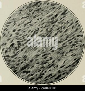 La pratique américaine de chirurgie : un système complet de l'art et la science de la chirurgie . La croissance commence généralement à partir de la moelle osseuse, d'où l'termsometimes adressé à elle, sarcome myéloïde (Fig. 102), et au cours de sa croissance Amérique 330^ SLUGERY Iciuls- pratique de beaucoup le Circ fait ion et la destruction de l'os.^ La coque extérieure en isthinned plus dense et peut être trouvé oAcr la surface de la tumeur dans la forme d'thinplates, qu'à la palpation donnent une sensation curieuse comme la déformation de l'enveloppe de l'oeuf(egg-shell grésille). Dans le processus alvéolaire l'unicellulaire géant kaposi forme un va-ri Banque D'Images