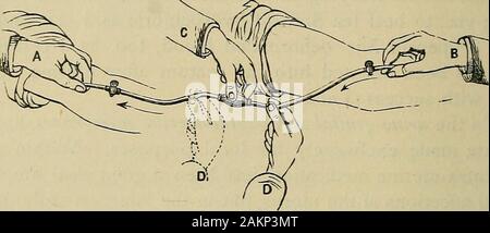 Matière médicale et de thérapeutique : pour les médecins et les étudiants . il glande thyroïde. 5. L'injection de médicaments dans les veines a été l'occasion-ally pratiqué. L'opération est, cependant, contestable, du danger de l'introduction d'air dans la circulation ; et il isseldom ont eu recours à, sauf dans le cas de transfusion de bloodafter hémorragie utérine ou autres, ou maladie épuisante. La transfusion sera souvent trouvé un remède efficace, est toujours althoughthere risque de coagulation du sang dans les veines.la plus directe et immédiate de la transfusion, le plus sûr, comme Avelings theoperation par app Banque D'Images