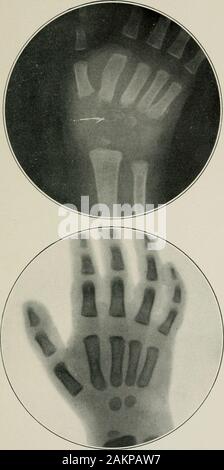 La pratique américaine de chirurgie : un système complet de la science et l'art de l'âge de la chirurgie ..La plus grande partie du carpe a été ossification cartilagineux ; avait apparu seulement dans deux os de thecarpus, à savoir, l'os magnum et le unciform, et dans la partie inférieure de l'épiphyse de rayon. La radiographie montre l'invasion de tuberculeux ces deux os carpiens et des extrémités proximale de l'os métacarpien troisième et deuxième. L'apparence caractéristique sont à la fois appréciés par com-transformant la radiographie du poignet malades (Fig. 1) avec que du son côté (Fig. 2). Le patienthad exhib Banque D'Images