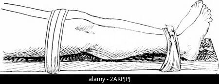 Accidents et urgences ; un manuel sur le traitement des urgences médicales et chirurgicales en l'absence d'un médecin . Fig. 15.-forfracture lowerjaw le bandage de l'os. 54 ACCIDENTS ET URGENCES dans toutes les fractures humide chiffons avec de l'eau frais peut être appliqué à la surface, de manière à éviter, autant que possible, le swellingwhich vient habituellement sur peu de temps après une fracture, et qui souvent en-terferes beaucoup avec l'examen du chirurgien. Les attelles.-Il n'y a rien dans lequel il y a un plus grand appel foringenuity et la fertilité des extemporizing splintsfor ressource que sur des os brisés. Pasteboar Banque D'Images