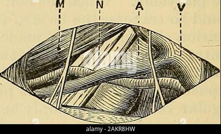 La science et l'art de la chirurgie : être un traité sur les maladies, blessures chirurgicales, et des opérations . Fig. 3SS.-Diagi-am de^ Arteryin sousclavière droite Troisième Partie de son cours. A. Artère, n. Bra-chial des nerfs du plexus Plexus v., de veines, m.Bord de muscles scalenus anticus, inséré dans tu-bercle de première côte.. Fig. 389.-diagramme de sous-clavière droite Ar-tery en troisième partie de son cours, traversé bytransversalis colli artère et veine. a. Sous-clavian artère. C. veine jugulaire externe receivingtransversalis colli veines, n. Plexusof brachiale nerfs, m. Muscle omo-hyoïdien. Il y a plusieurs points dans connecti Banque D'Images