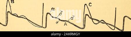 Manuel de médecine clinique et diagnostic physique . Il pulse à deux poignets être orequal isochrones pas-si les battements ne se produisent pas en même temps nous devons-maladie suspecte de l'un ou l'autre des artères radiale,ou que la pression se fait sur une partie de l'arterialtract entre le cœur et le poignet par une tumeur, aneu-rism, &c. Les sphygmo Étude graphique de l'impulsion.*-Thesphygmograph est un instrument par l'utilisation de qui thepulsations de l'artère radiale sont représentés dans le diagramme.Un levier sensible armé d'un point à l'angle droit à l'arbre est fait pour vous déplacer vers le haut et vers le bas en plaçant de plus oneend il Banque D'Images