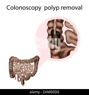 Retrait du polype de coloscopie, illustration Banque D'Images