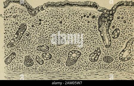 Traité de médecine et de thérapeutique . pylorique. - Transformationmuqueuse camping. - Il ne reste, dans le tissu interstitiel épaissi etscléreux glandesanciennes, aucune trace des. - Grossissement 100 mètres de diamètre. 358 G. HiYEM ET G. LION. - MALADIES DE LESTOMAC. Au deuxième stade, la transformation se dessine et tonne voit seproduire aux dépens de lépithélium proliféré des collerettes des bour-geons embryonnaires qui poussent des prolongements simples oudigités dans les cavités des glandes anciennes, auxquelles ils se faire l'vontbientôt. La muqueuse paraît alors formée de deuxétages de violation Banque D'Images