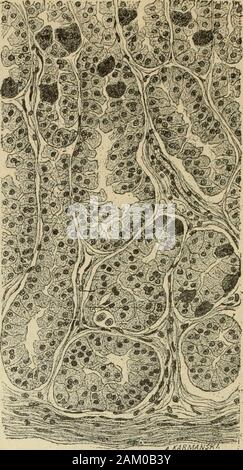 Traité de médecine et de thérapeutique . transformée en une escarre. GASTRITES CHRONIQUES. -Les gastrites chroniques peuventse diviser en : 1° gastrite parenchymateuse ou glandulaire ; 2° gastriteinterstitielle ; 3° gastrite mixte ; enfin il existe deux modes determinaison de these processes : 1° la transformation muqueuse  ; 2° latrophie. I. Gastrite parenchymateuse ou glandulaire. - La gastriteparenchymateuse pur, sans épaississement du tissu interstitiel, est laplus rare des gastrites. Elle comprend deux formes : lhyperplasiqueet la dégénérative. A. La gastrite hyperplasique parenchymateuse af Banque D'Images