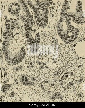 Traité de médecine et de thérapeutique . Fi " 9.- partie dune coupe dela région peptique. - Étatgrenu etcellules (cellules principales de bordure). - Gros-sissement 300 diamètres. Fig. 10. - Coupe de la dune partie régionpeptique. - Partie inférieure des tubes. -Dégénérescence translucide des éléments (cel-lules de bordure). Dabsinthisme - Cas. -Grossissement 300 diamètres. cibsinthique) (fig. 10). Elle débute, comme la précédente, par unemultiplication cellulaire et un état grenu des cellules multipliées.Le corps de ces éléments fixe mal les colorants habituels, alors que lesnoyaux sont enc Banque D'Images