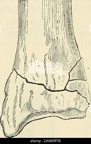 La chirurgie moderne, général et du dispositif . la réalité, une forme de com-Procès-verbal de fracture. De multiples fractures ou composite est une condition dans laquelle l'os est un intomore cassé de deux pièces, les lignes de fracture, d'intercommunication ou pas un con-dition dans laquelle deux ou plusieurs os sont brisés. Des fractures multiples d'un boneare divisé en double, triple, quadruple, etc. de multiples fractures des os d'un involvingmore sont rarement vu, et représentent moins de 2  % des cas, offracture. La raison de leur rareté dans les hôpitaux, c'est qu'ils résultent de la force fromsevere et beaucoup de victimes meurent avant qu'ils peuvent être Banque D'Images