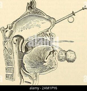 La chirurgie moderne, général et du dispositif . Mais aggravatevenous les saignements. Pressiire ci-dessous une blessure peut arrêter une hémorragie veineuse, butincrease saignements artériels. 32. Une épistaxis modérées, ou des saignements de nez, peut être arrêté byan injection d'hydrogène Peroxyde d', une injection d'une solution d'antipyrine,ou une injection de solution Carnots de gélatine. Les favoris expe-dients sont maintenant les bras levés au-dessus de la tête et appljdng la glace arrière du cou. L'épistaxis sévère en examiner le nez par tête de l'OOF-miroir et d'un spéculum. Si un point d'ulcération Uttle est trouvé, par un touchit cau Banque D'Images