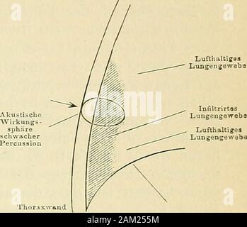 Lehrbuch der klinischen Untersuchungs-Methoden : für Studirende und Aerzte guide pratique . Le ThorAx^rand Zwerchfell. I. Pleuritisclies Exsudat. ZwerclifoU II. Oberfläcliliclier Infiltrationsherd. Kl. Inflltrationiherde Banque D'Images