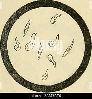 Des inflammations et catarrhe de la vessie, gravelle, des divers moyens de combattre ces sentiments . Épithélium pavimenteux de la vessie. saurait les confondre avec celles qui viennent desuretères et des berceaux, qui sont allongées au con traire, soitàune etressemblent-larme, soit à un fuseau{fig. 22) , ni avec celles qui viennent de lurèthre Fig. 22.. Cellules épithéliales provenant clés uretères , des moïses,des calices. (Fig. 23), qui sont plus grandes et transparentes.Quant aux cellules épithéliales qui se détachent des - 112 - Fig. 23. Banque D'Images