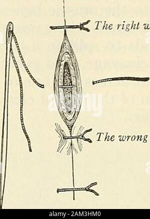 La chirurgie moderne, général et du dispositif . nerf, un tendon, ou un muscle isdiT.ded, et si ce dommage est découvert, sutmre à la fois (fig. 109 et no).Si l'woimd est vaste et profond, il peut être nécessaire d'utiliser des suturesin enterrés afin de tenir les côtés de la plaie en contact. Si la surface d'une approximation, mais woundis les profondeurs ne sont pas, le caaty becomesfilled ou espace mort avec du liquide, et l'infection se produit presque certainement. Si les sutures enfouies havenot été utilisés, tels une cavité doit être oblitérée par la pression sur les applicationof judicieuse surface. C'est par l'adaptation d'seciired Banque D'Images