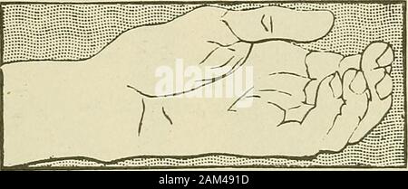 La thérapie médicale et chirurgicale . doigts ; contrat partiellement le thenarmuscles, qui d'abord ont été paralysés, commencent. torecover Dans les deux cas qui nous illustrer il y avait des lésions vasculaires, anassociated compensatedfor assez bien dans la plupart des égards, et l'irritation de l'secretoryfibers ce qui a conduit à la transpiration excessive dans le medianarea (figs. 52-54). Lésions des nerfs CUBITAL ET MÉDIAN 115 Enfin, dans tous ces différents types le montant de l'ofparalysis interossei fléchisseurs et devrait être notedon l'une part ; et, d'autre part, la force des extenseurs lombaires, lésions vasculaires associées, Banque D'Images
