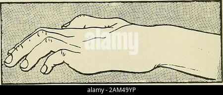 La thérapie médicale et chirurgicale . Fig. 48.-associée de la lésion des nerfs cubital et médian dans fromwound la région cervicale (deuxième type). Motorsymptoms sont plus marqués dans les petits muscles de thehand. phalanges des quatre doigts est si grande qu'elle causea de la subluxation de la tête des boneswhich métacarpien projet dans la paume de la main à la base des doigts (fig. 47). La flexion de la deuxième phalange est bon, que de la. Fig. 49.-associé de paralysie ulnaire et médian nervesfrom blessure de l'arm (troisième type). Motorsymptoms sont plus marqués dans les petits muscles etdans les fléchisseurs profonds. Banque D'Images