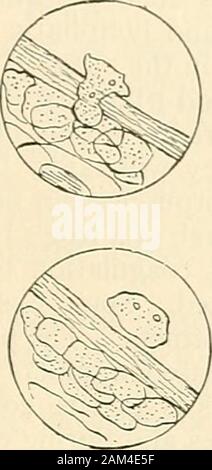 La chirurgie moderne, général et du dispositif . Fig. 47.-étapes de la migration d'un seul sang blanc-corpuscule à travers la paroi d'une veine (Caton). Migrations et.-Diapédèse même au début de l'inflammation d'un certain nombre de globules blancs passent par le navire waUs ; mais quand le inflammationis estabhshed l'UEO, un grand nombre, et lorsqu'elle est sévère vastes hordes, passer dans les tissus périvasculaires. Ce processus est connu sous le nom de migration (Fig. 46 et47). Les leucocytes jeter bras protoplasmiques, s'insérer entre les cellules des parois des thevessel themselvesthrough pifll, et par leur puissance ofameboid mo Banque D'Images