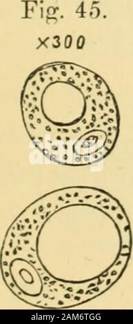 Les maladies de l'ovaires : leur diagnostic et leur traitement . Fig. 46. Fig. 47. X300 Banque D'Images