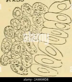 Les maladies de l'ovaires : leur diagnostic et leur traitement . Si, au contraire, les alvéoles sont moins densément remplie, theepithelial cellules pourront développer dans les directions radiale et fromlateral la compression sera assumer l'apparence d'épithélium cylindrique (fig. 37). Fig. 37.. Fig. 38. Banque D'Images