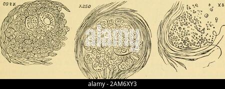 Les maladies de l'ovaires : leur diagnostic et leur traitement . Les grandes alvéoles sont plus ou moins circulaire (fig 31, 32, 33).Fig. 81. Fig. 32. Fig. 33.. Les espaces sont remplis avec les cellules et noyaux, surtout rétablir de segmentation. La plupart sont petites, globulaire, trans-parent corps avec une marge extrêmement délicate, renderedmore distincts par ajout d'eau (fig. 34, 35). Fig. 35. Banque D'Images