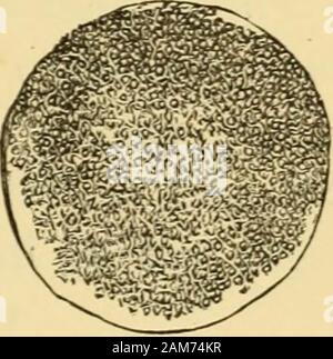 Les maladies de l'ovaires : leur diagnostic et leur traitement . ). Ces derniers peuvent facilement être confondues avec des cellules nucléées, towhich ils portent une ressemblance étroite, les colloïdes globules. 97 Fig- sous le compresseur, ces agrégations de granules granules unique, qui burstinto flattenfrom généralement la pression et devenir des confluents.où les agrégations sont entourés par adark marge, il peut souvent être observedhow cette marge de theenclosed supprime progressivement les granulés, devient pâle et finallydisappears. Xo briser d'un envelopecan être observé. Ils se composent seulement offatty granulés, agglomer Banque D'Images